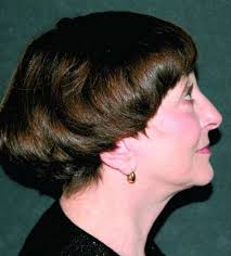 Fighting the signs of an aging neck