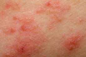 13 Common Causes For Itchy Butt Rashes And Bumps According To Mds