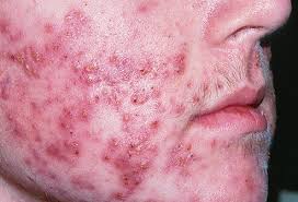 Check spelling or type a new query. Cystic Acne Picture Image On Medicinenet Com