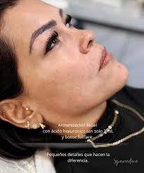 acidohialurónico #armonizacionfacial #botox #gdl #fillers