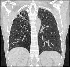 J'ai passé recement un scanner thoracique avec injection suite a une. Scanner Thoracique Ultra Basse Dose La Mort De La Radiographie Thoracique Sciencedirect