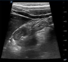 Image result for Intussusception