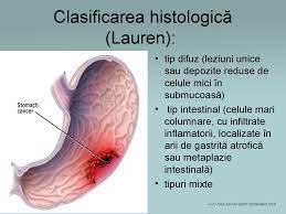 Maybe you would like to learn more about one of these? Carcinom Mamar Infiltrativ Cancer Mamar Infiltrativ