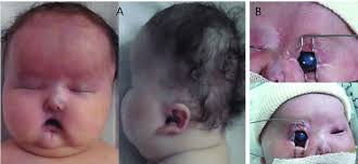 A) Patient 2 shows a prominent forehead, sparse hair especially in...