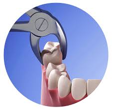 Image result for Tooth Extraction