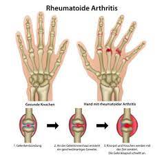 Arthritis Ursachen Symptome Und Behandlung Gelenk Klinik De