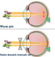 Gozluk Hakkinda Her Sey Gozdr Com Goz Sagligi Ve Hastaliklari