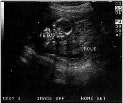 What to expect for moms with 4 weeks pregnant. Diagnostic Ultrasound In The First Trimester Of Pregnancy Glowm