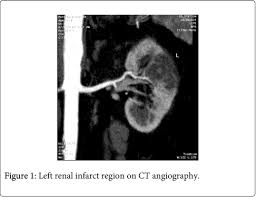 Image result for Renal Infarction