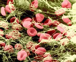 By breaking down the clot, the disease process can be arrested or the complications reduced. Coagulation Definition Factors Facts Britannica