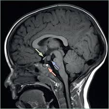 Image result for Precocious Puberty