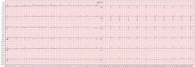 Image result for Electrocardiogram Validity