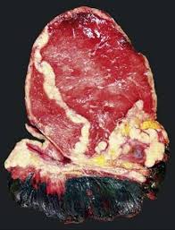 Malignant pleural mesothelioma is a dangerous cancer that affects the lining of the lungs (pleura). Malignant Mesothelioma Of Pleura Thoracic Pathology A Volume In The High Yield Pathology Series Expert Consult Online And Print 1st Edition