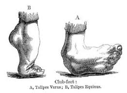 Image result for Clubfoot