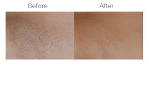 Laser hair removal in tacoma on superpages.com. Laser Hair Removal Gallery Puyallup Wa Eterna Vein Medical Aesthetics