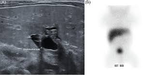 Maybe you would like to learn more about one of these? Clinmed International Library A Rare Case Of Biliary Atresia And Choledochal Cyst In A Premature Infant International Journal Of Surgery Research And Practice