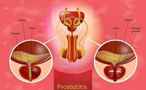 Image result for Chronic Bacterial Prostatitis