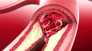 Coronary artery disease develops when the major blood vessels that supply your heart become damaged or diseased. Coronary Artery Disease Cad Cardiac Surgery Michigan Medicine University Of Michigan