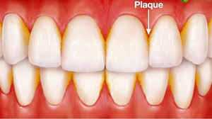 Now that you have some plaque removal home remedies to try out, it's time to talk about issues related to plaque buildup. The Best Way To Remove Plaque From Teeth Monroe Family Dentistry