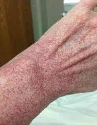 In ttp, blood clots form in small blood vessels throughout the body. About Itp Itp Australia