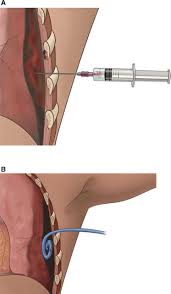 Image result for Small Caliber Chest Tube