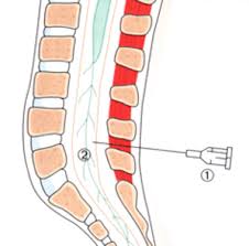 Wineskin (flexible container for liquids). Universitatsklinikum Heidelberg Anasthesieverfahren