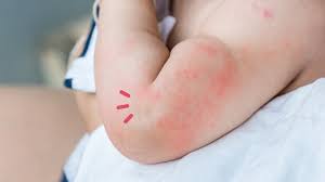 Pada kondisi ini, biasanya muncul bintik merah pada kulit bayi setelah demam dan tidak menimbulkan kulit menjadi kering dan mengelupas setelahnya. Menangani Ruam Kulit Balita Yang Disertai Demam Orami