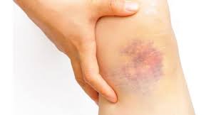 Sakit lutut kronik juga berlaku disebabkan penyakit sistemik (penyakit dalam badan seperti gout). Punca Sakit Lutut Kiri Ketahui 8 Punca Penyebab Sakit Lutut