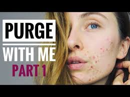 To learn more about salicylic acid and why it is able to absorb so quickly into the skin, let's take a look at where it comes from next. Salicylic Acid Purge Week By Week Decongest Skin Youtube