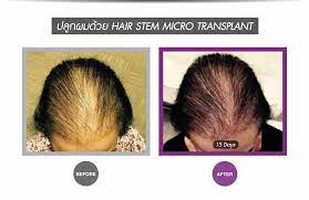With this discovery, scientists may be able to grow natural looking hair for bald men. Breakthrough Stem Cell Treatment For Hair Loss Apex Profound Beauty