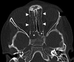 Image result for Sinus CT