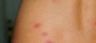 Image result for bedbugs bites