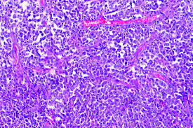 The most common symptom of lymphoma is the development of lumps under the skin. Older Age R R Disease In Lymphoma Patients Tied To Increased Covid 19 Death Rate Mdedge Hematology And Oncology