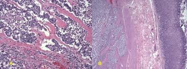 Colectomy with colocolonic, ileocolonic, or jejunocolonic anastomosis may be performed depending on the extent of the disease. Colocolonic Anastomosis Webmedcentral Com Vascular Risk Factors In Left Colon To Learn More Go To Niti Surgical Solutions Chinese Food