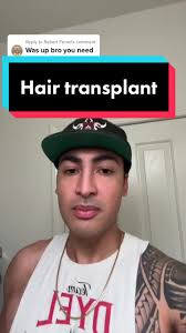 Hair Transplant Update: 3 Months In