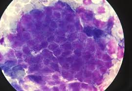 Benign tumors are not cancer and they do not spread or invade. Mri Tool Can Diagnose Difficult Cases Of Ovarian Cancer Imperial News Imperial College London