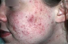 Deze pillen zijn officieel geregistreerd voor toepassing bij vette huid, acne en snorvorming, en niet als anticonceptiepil. Acne Wat Je Kunt Doen Tegen Acne Huidarts Com