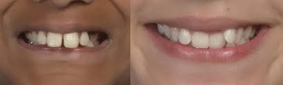 Are You Facing Snaggle Tooth Problem? Discover Its Unexpected Effects Now!  - Dentalwellnesshub.Com