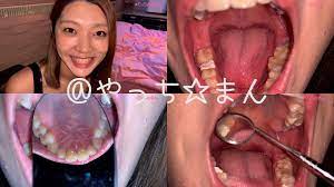 個人撮影】実はエッチな近所のお姉さんの歯観察 香苗レノン【Y-221】 | アダルト動画・画像のコンテンツマーケット Pcolle