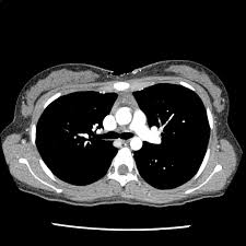 Image result for Cardiac Contusion