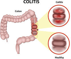 Ein indirekter nachweis einer glutenunverträglichkeit ist durch ihre symptome möglich. Weihrauch Und Myrrhe Stoppten Meine Darmentzundung Ulcerative Colitis Colitis Ulcers
