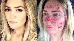 22.01.2021 · if you are questioning the health of a blemish or mole, you should schedule a skin cancer screening with a dermatologist without delay. Woman S Skin Cancer Selfies Go Viral And Inspire Skin Checks Allure