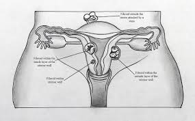 Uterine Fibroids Intermed P A With this tool you can calculate the intersection(s) of list of elements. uterine fibroids intermed p a