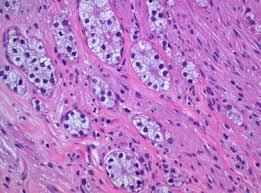 Gastrointestinal carcinoid tumor treatment often includes resection of the primary tumor and local lymph nodes. Tumor Carcinoide De Celulas Claras Rico En Lipidos Del Apendice Cecal Sciencedirect