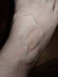 Beule Am Fuss Fuhlt Sich Weich An Gesundheit Und Medizin Gesundheit Fusse