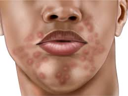 Some rashes may need no treatment and will clear up on their own, some can be treated at home; Secondary Syphilis Causes Symptoms Diagnosis