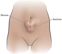 About Your Abdominal Incisional Hernia Surgery Memorial Sloan Kettering Cancer Center