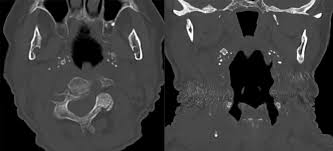 Image result for Tonsillolith