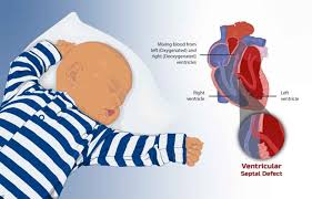 Image result for Ventricular Septal Defect