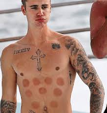 Even though it looks aggressive, the marks will disappear over time. The Myths Truths Behind Myofascial Cupping Therapy Back In Health Osteopathy